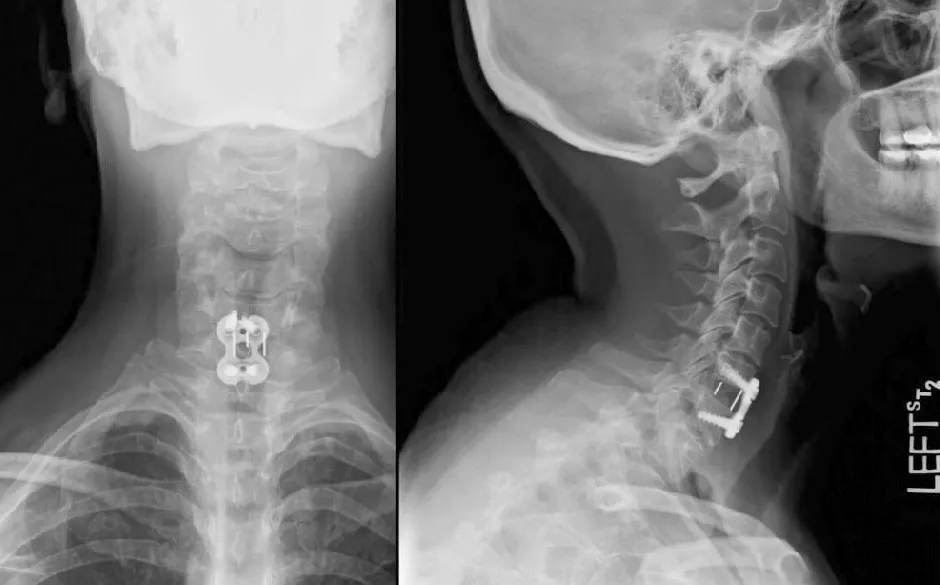 Jak długo trwa leczenie skręcenia kręgosłupa szyjnego i co warto wiedzieć