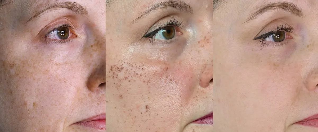 Przebarwienia po pryszczach: Skuteczne metody i składniki, które działają