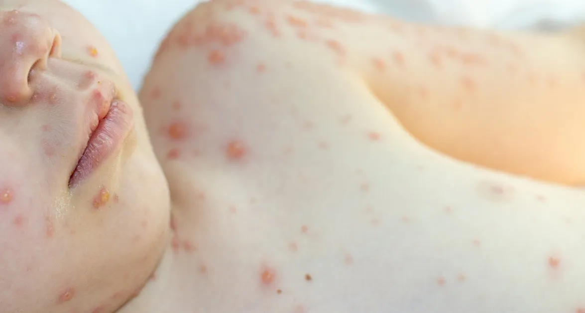 Szkarlatyna kiedy do przedszkola? Sprawdź, kiedy dziecko może wrócić