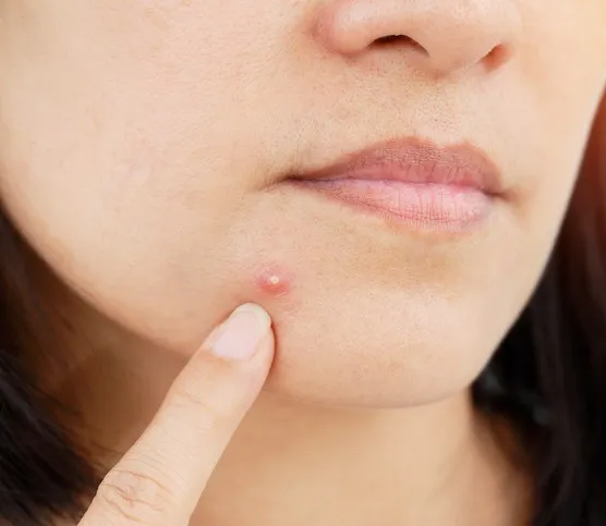 Jak skutecznie pozbyć się pryszcza na ustach i uniknąć bólu