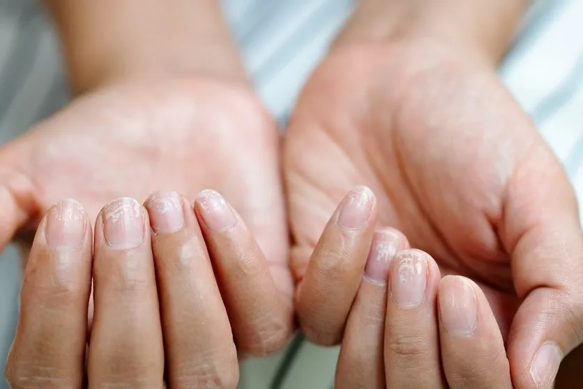 Jak skutecznie przestać obgryzać paznokcie i odzyskać zdrowe dłonie
