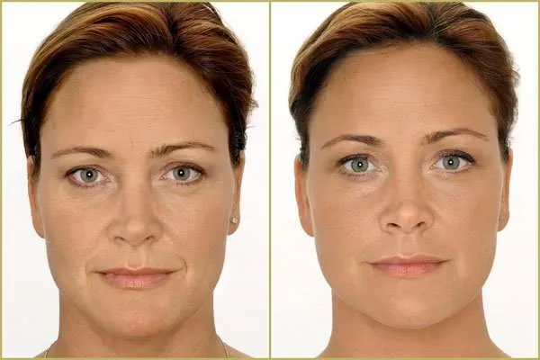 Zmarszczki palacza: Botox czy kwas hialuronowy - co wybrać?