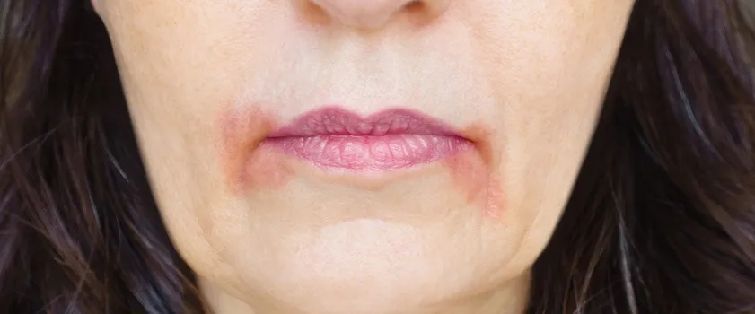 Zapalenie Wokół Ust: Zrozum Dermatozę Okołoustną, Zdjęcia i Leczenie Zapalenia Skóry