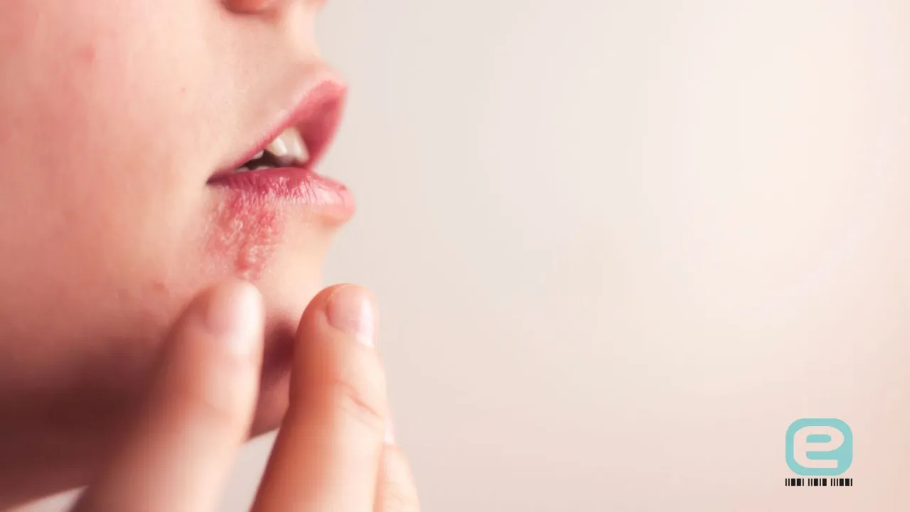 Skuteczne sposoby na pryszcz w nosie - jak się go pozbyć?