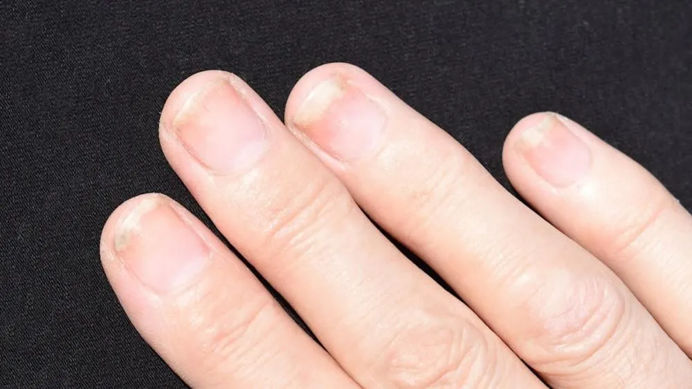 Jak skutecznie leczyć grzybicę paznokci u rąk po hybrydzie?