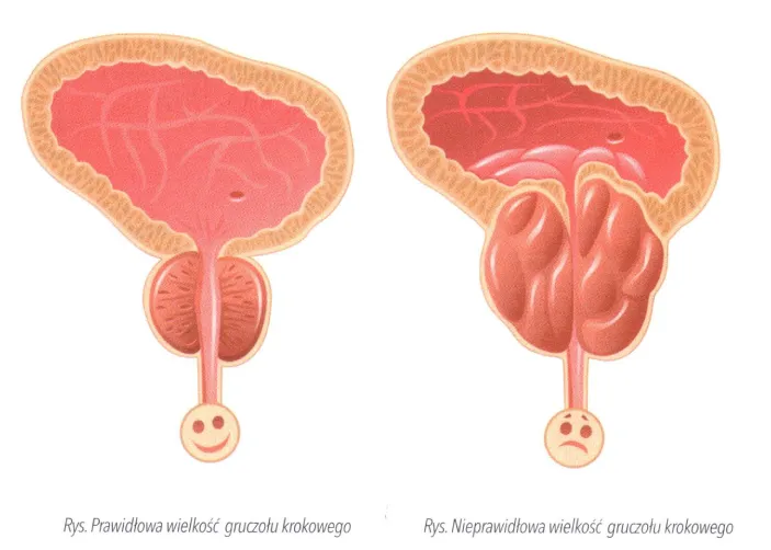 Objawy raka prostaty u mężczyzn - nie bagatelizuj tych sygnałów