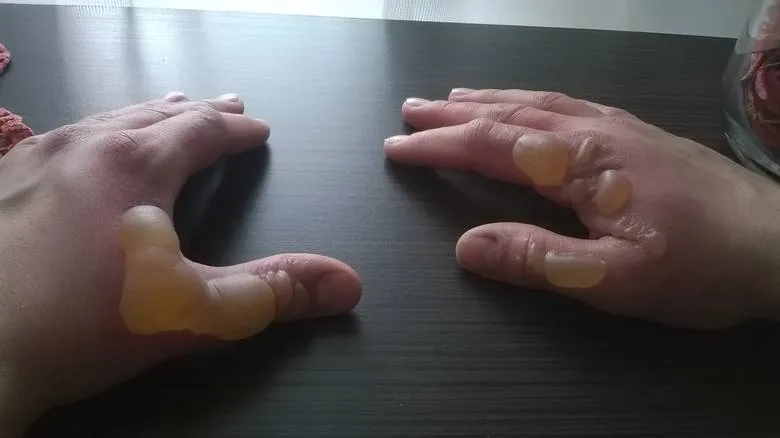 Oparzenie gazem LPG co robić: skuteczne metody leczenia i pierwsza pomoc