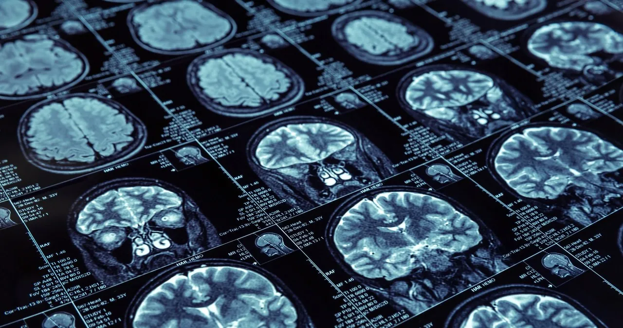 Jak zapobiec Alzheimerowi: skuteczne metody na zdrowy mózg