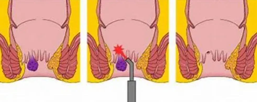 Jak skutecznie leczyć szczelinę odbytu? Od leków po Botoks