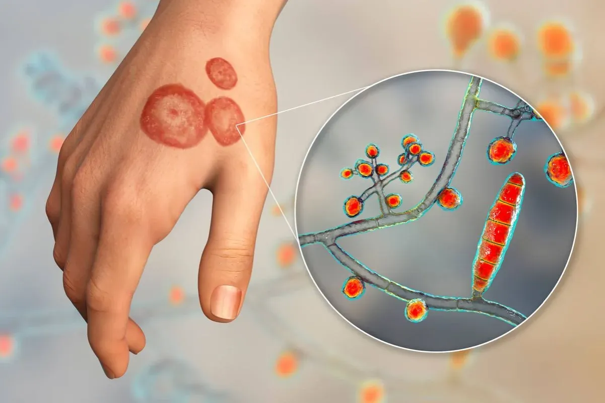 Grzybica: Znaczenie totalnej biologii w diagnozie i terapii
