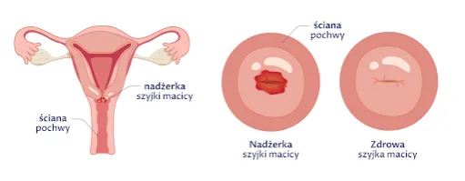 Obniżenie szyjki macicy objawy – jak rozpoznać niepokojące symptomy