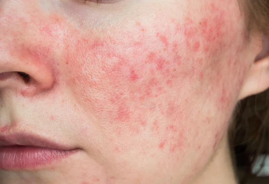 Trądzik różowaty przyczyny: Co wywołuje tę uciążliwą chorobę?