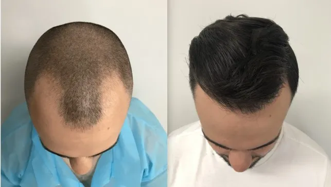 7 fryzur męskich z rzadkimi włosami, które dodadzą im objętości!