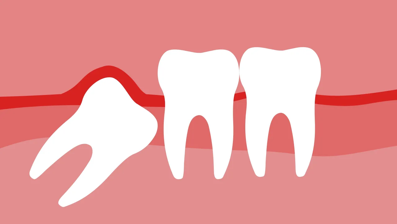 Poradnik: Jak przygotować się do usunięcia ósemek