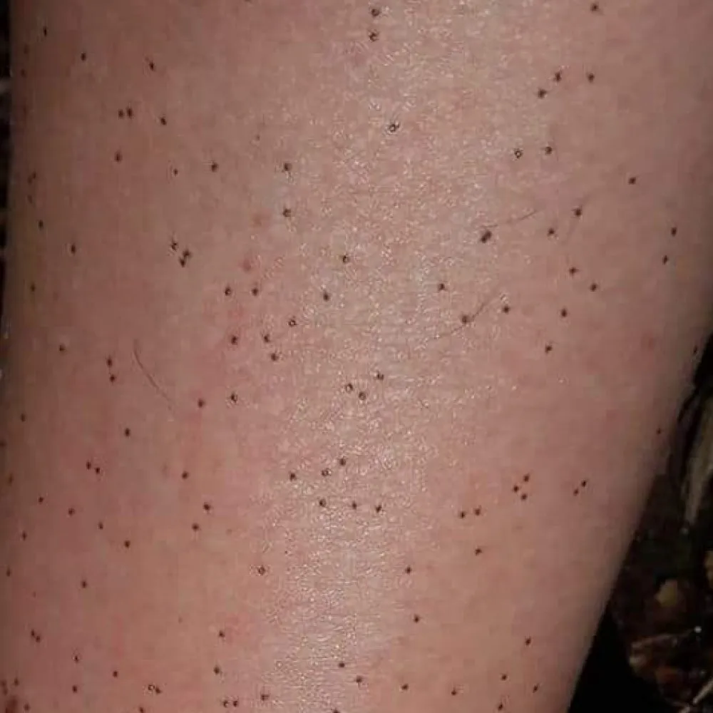 Jak wygląda mały kleszcz i jak go rozpoznać, by uniknąć zagrożenia Jak wygląda mały kleszcz i jak go rozpoznać, by uniknąć zagrożenia