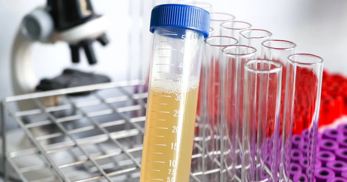 Czego nie robić przed badaniem moczu, aby uniknąć błędnych wyników