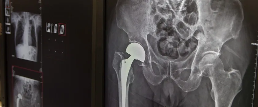 Obluzowanie endoprotezy stawu biodrowego – objawy, które mogą niepokoić Obluzowanie endoprotezy stawu biodrowego – objawy, które mogą niepokoić