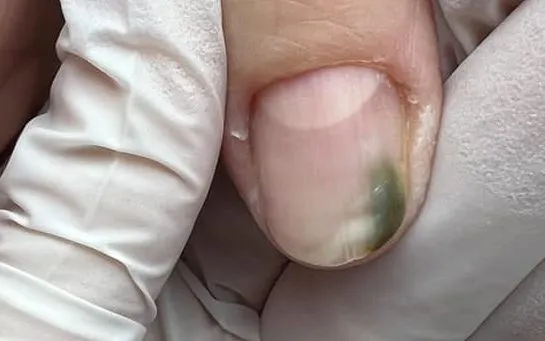 Jak leczyć zieloną bakterię na paznokciu i uniknąć powikłań