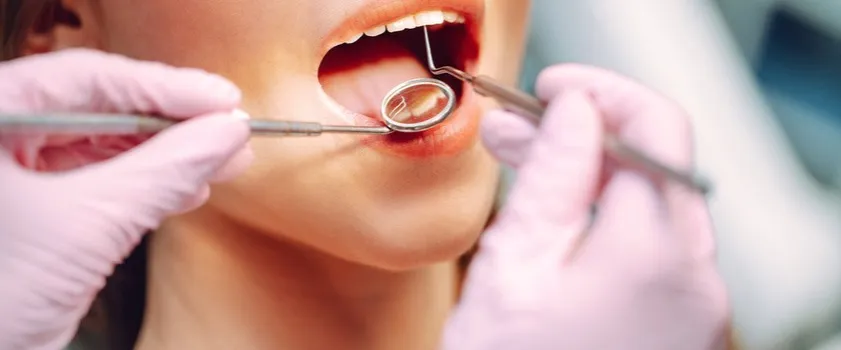 Jak leczyć próchnicę między zębami i uniknąć poważnych problemów