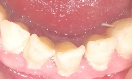 Czy usuwanie kamienia jest na NFZ? Sprawdź, co jest refundowane Czy usuwanie kamienia jest na NFZ? Sprawdź, co jest refundowane