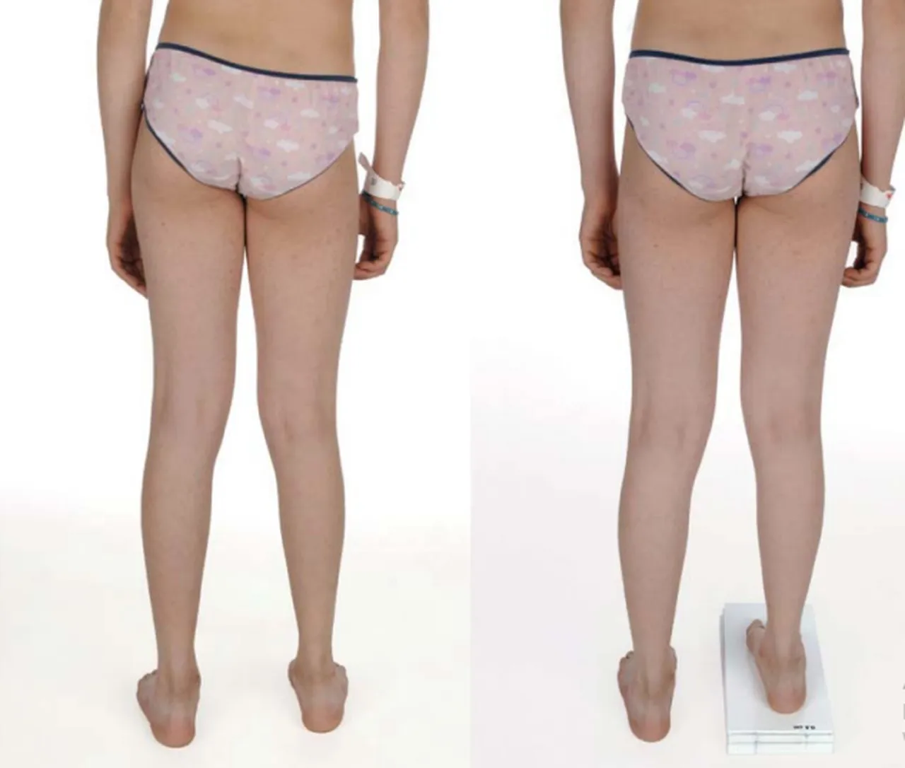 Jedna noga krótsza: przyczyny, objawy i skuteczne leczenie