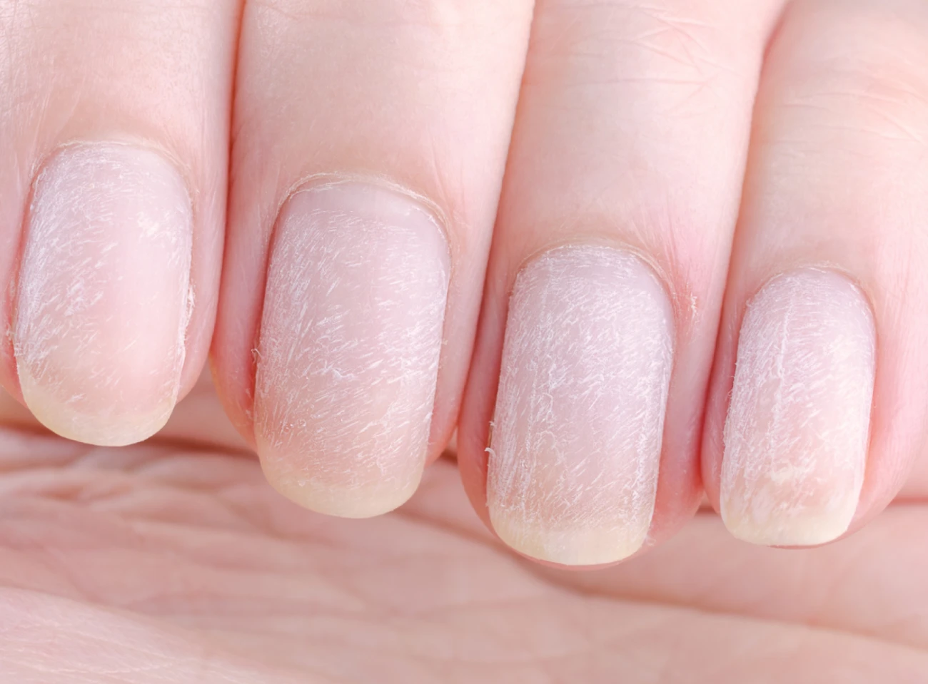 Uszkodzona macierz paznokcia: objawy, leczenie, regeneracja