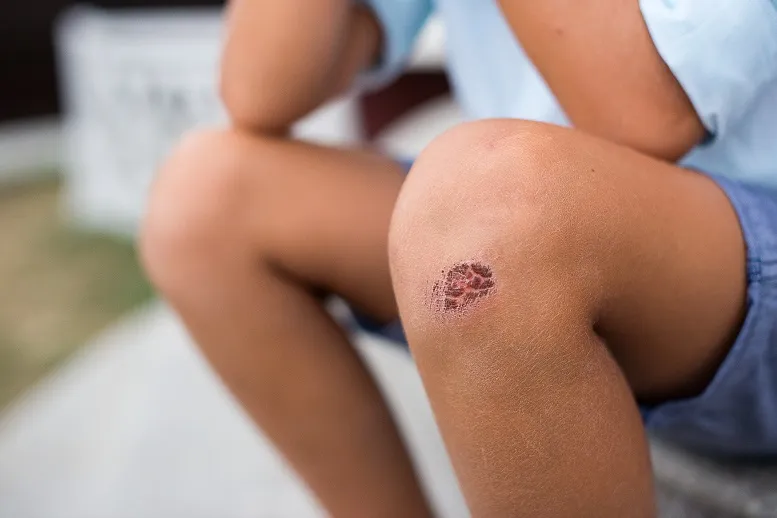 Ile goi się strup po pryszczu? Oto, co musisz wiedzieć, aby uniknąć blizn