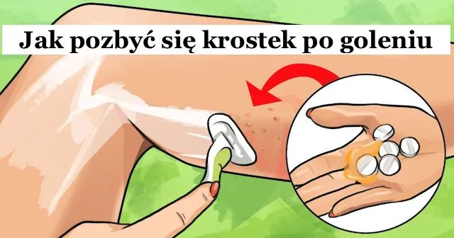 Jak pozbyć się krost po goleniu bikini - skuteczne metody i porady