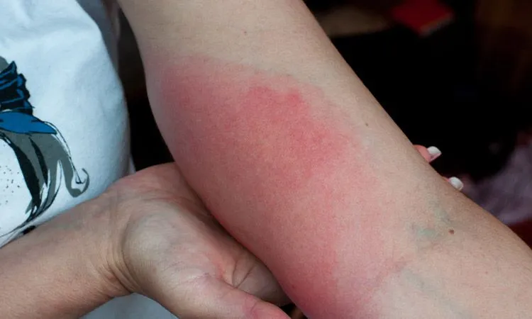 Po jakim czasie wychodzi rumień po kleszczu? Objawy, które musisz znać