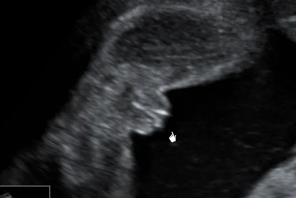 Kiedy w ciąży można poznać płeć dziecka? Oto najważniejsze informacje