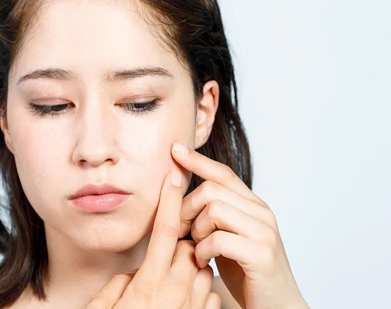 Jak wycisnąć pryszcza bez ryzyka blizn i infekcji - krok po kroku