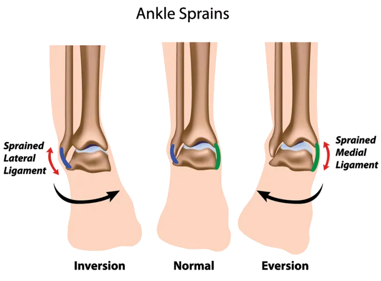 Skręcenie stawu skokowego - ile trwa leczenie i co warto wiedzieć