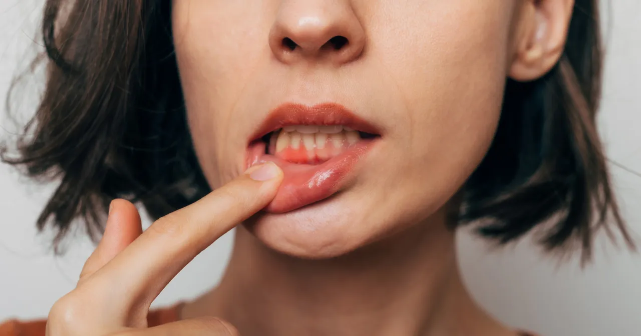 Jak usunąć jedzenie z dziąsła? Domowe sposoby i kiedy iść do dentysty