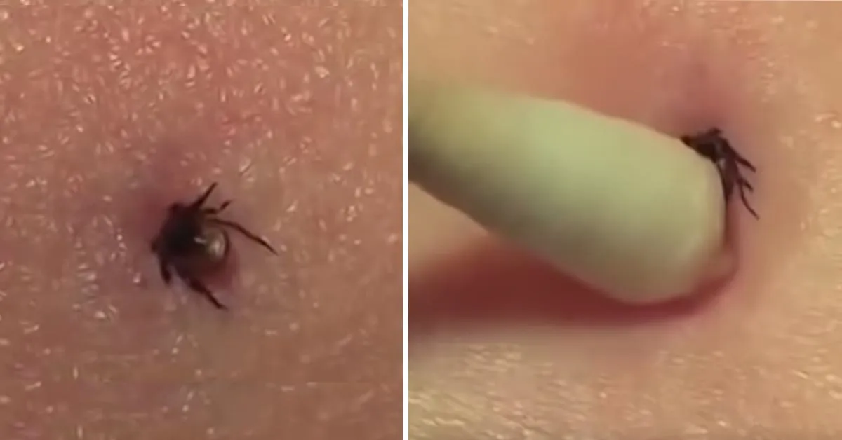 Jak usunąć kleszcza patyczkiem do uszu bez ryzyka infekcji