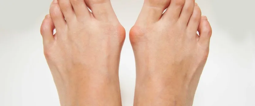 Haluksy: Od czego powstają? Poznaj 7 kluczowych przyczyn!