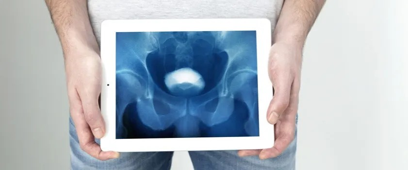 Jak zapobiec prostacie i uniknąć poważnych problemów zdrowotnych