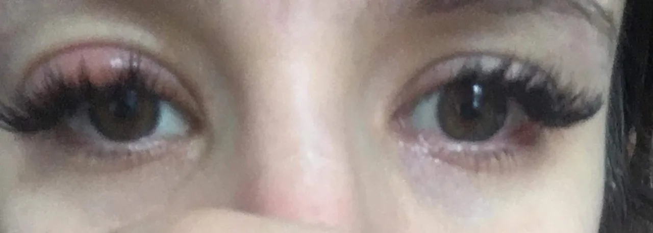 Uczulenie na tusz do rzęs objawy – jak je rozpoznać i unikać?