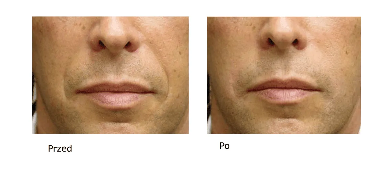 Co daje kwas hialuronowy? Odkryj jego niesamowite korzyści dla skóry