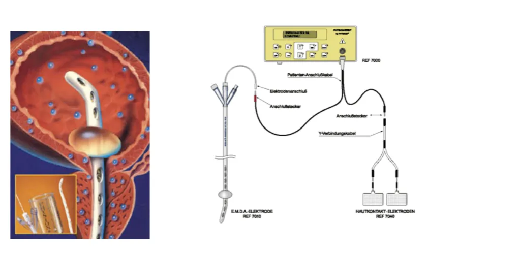Interstitielle Zystitis Diagnose: So finden Sie Klarheit