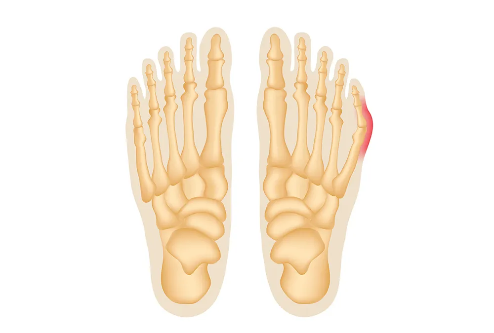Krzywy palec u nóg dziecka: przyczyny i skuteczne leczenie