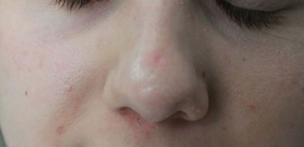 Jak przyspieszyć gojenie rany po pryszczu i uniknąć blizn