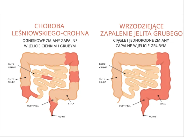 Choroby autoimmunologiczne jelit: 5 głównych przyczyn i terapii