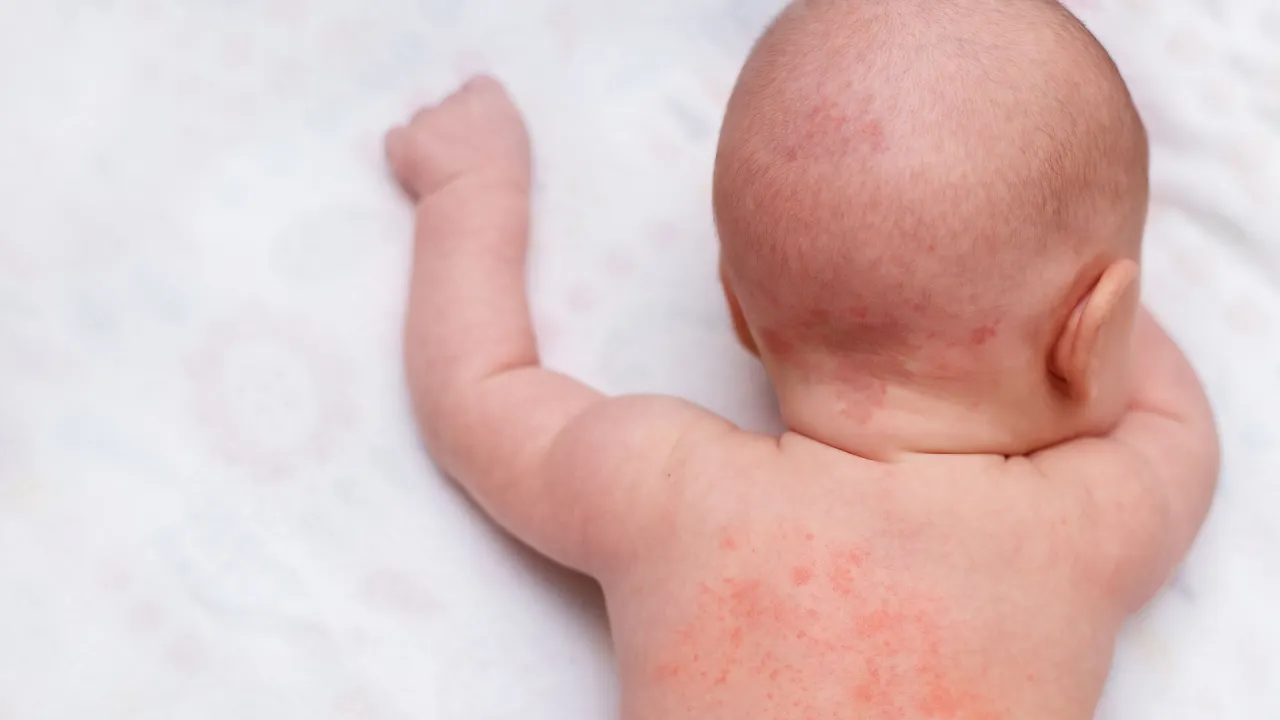 Skaza białkowa u niemowląt: niebezpieczne objawy potówek, które musisz znać