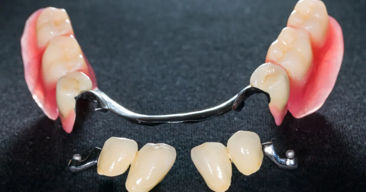 Jak często przysługuje proteza zębowa nfz i co musisz wiedzieć Jak często przysługuje proteza zębowa nfz i co musisz wiedzieć