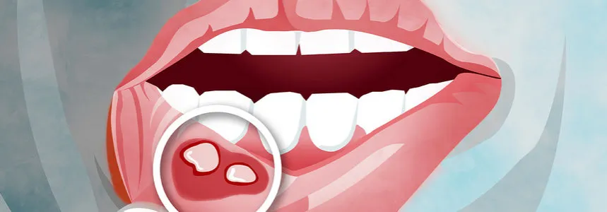 Choroba Leśniowskiego-Crohna: objawy w jamie ustnej, które musisz znać