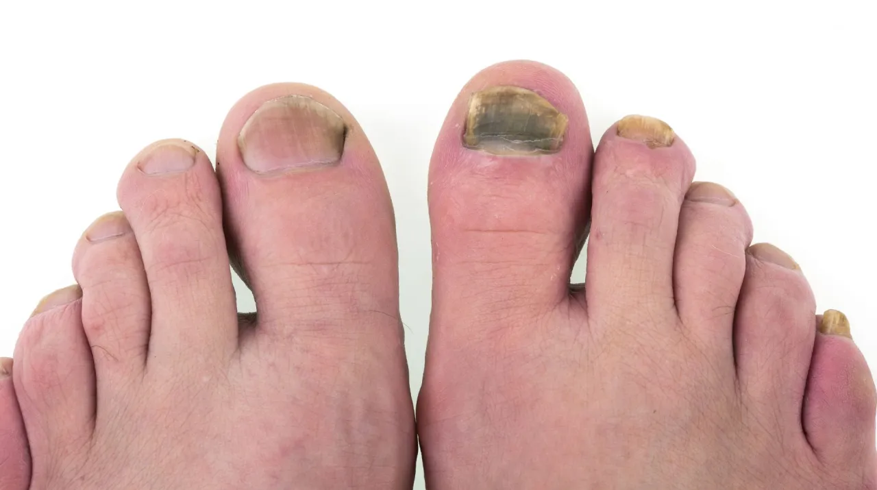 Grzybica paznokci czy uraz mechaniczny? Jak rozpoznać problem i kiedy udać się do podologa