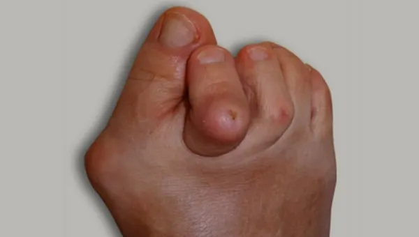 Opuchnięte i zaczerwienione palce u nóg: przyczyny i leczenie