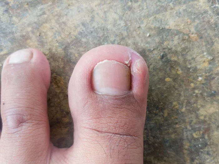 Jak wygląda wrośnięty paznokieć? Objawy i skutki, które musisz znać