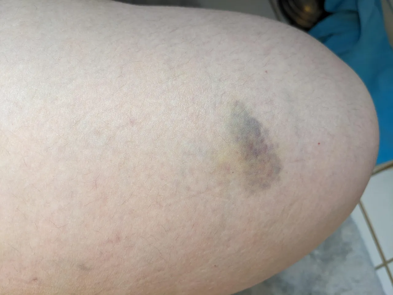 Siniak po tatuażu: Kiedy należy się martwić?