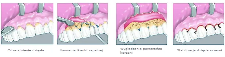 Ile trwa zdjęcie szwów z dziąsła? Szybki i bezbolesny proces